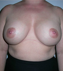 Breast Augmentation