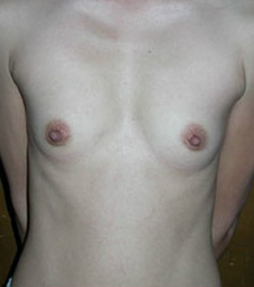 Breast Augmentation