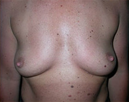 Breast Augmentation