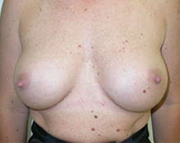 Breast Augmentation