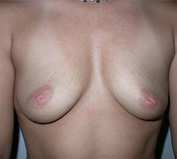 Breast Augmentation