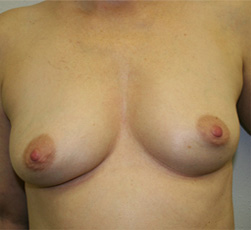 Breast Augmentation