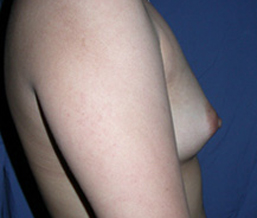 Breast Augmentation