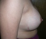 Breast Augmentation