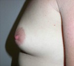 Breast Augmentation