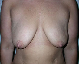 Breast Augmentation with Breast Lift