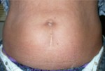 Tummy Tuck