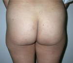 Gluteal Implant