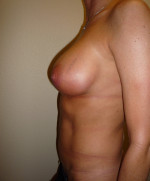 Breast Augmentation