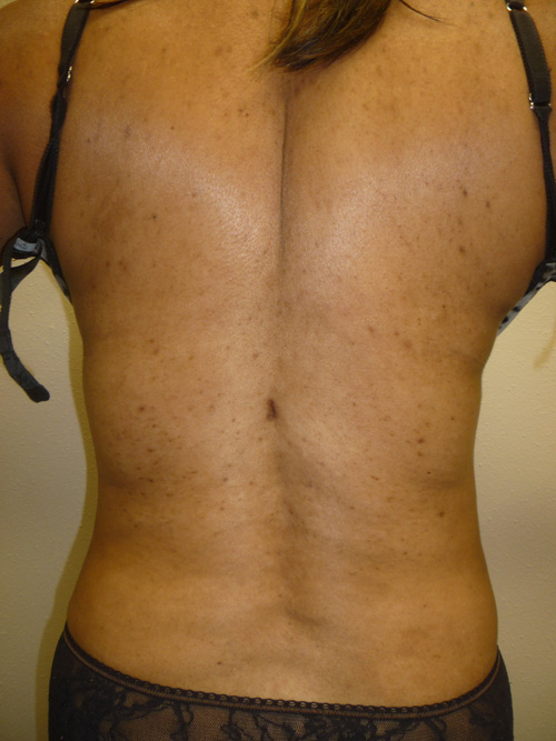 Liposuction