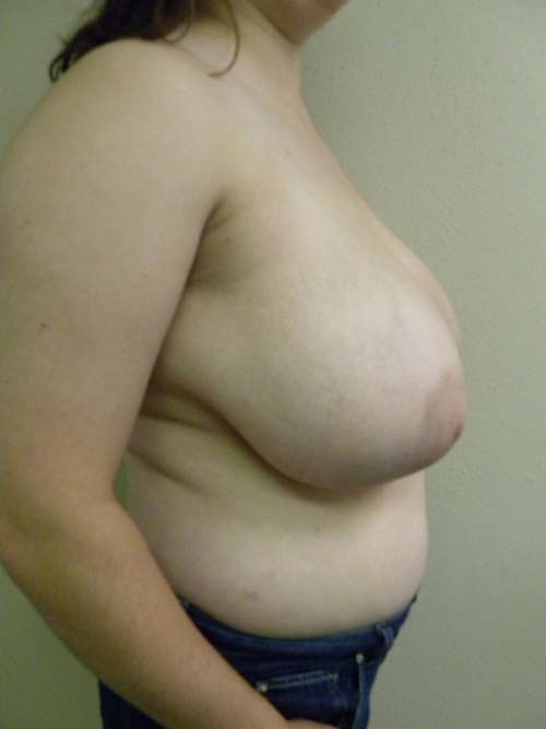 Breast Reduction