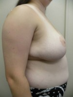 Breast Reduction