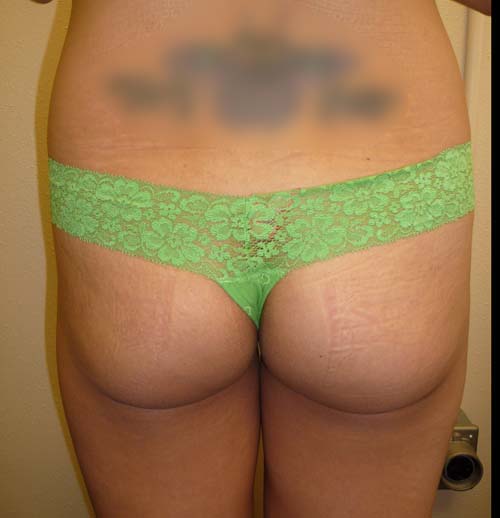 Gluteal Implant
