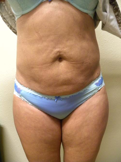 Liposuction