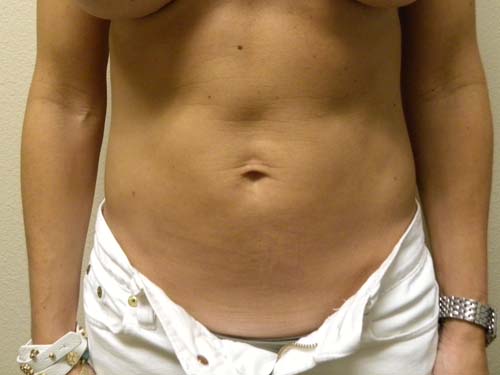 Liposuction