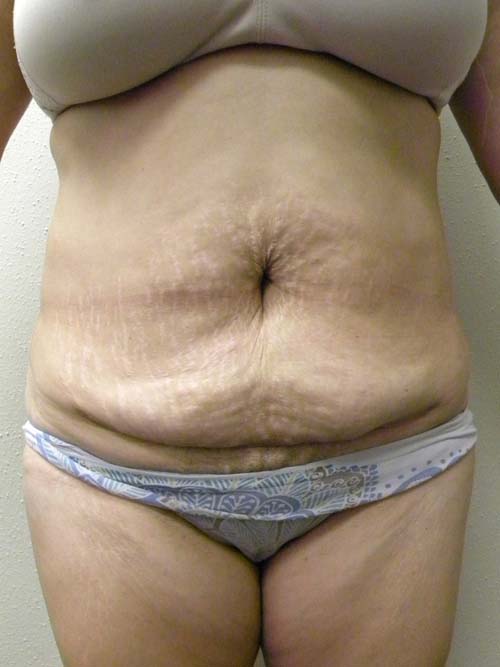 Liposuction