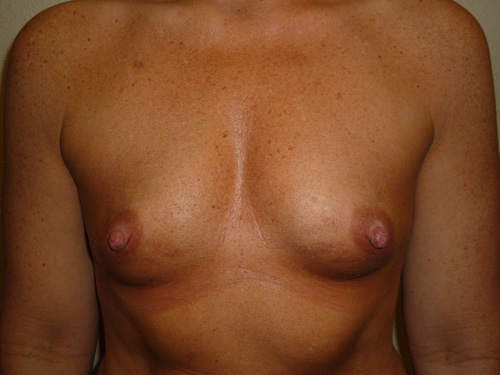 Breast Augmentation