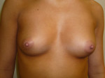 Breast Augmentation