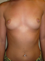 Breast Augmentation