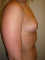 Breast Augmentation