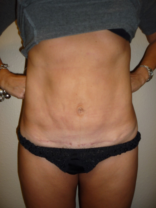 Mini Tummy Tuck