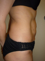 Mini Tummy Tuck