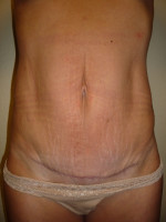 Mini Tummy Tuck