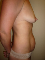 Mini Tummy Tuck