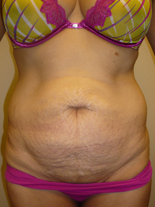 Mini Tummy Tuck