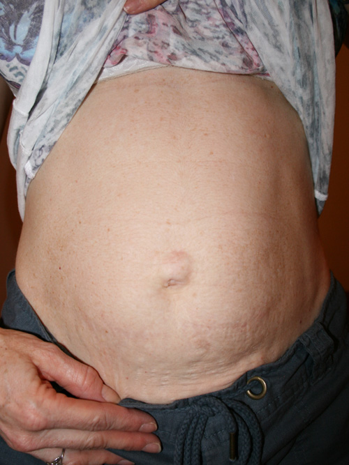 Mini Tummy Tuck