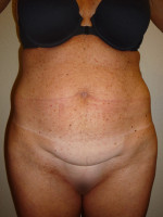 Mini Tummy Tuck