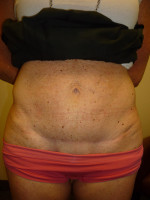 Mini Tummy Tuck