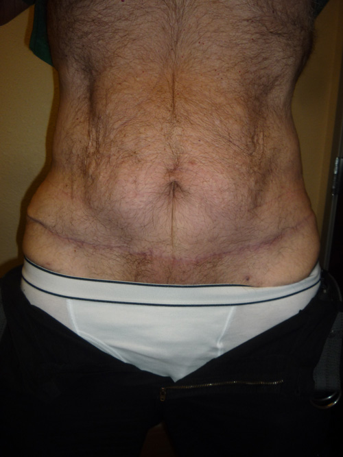 Mini Tummy Tuck