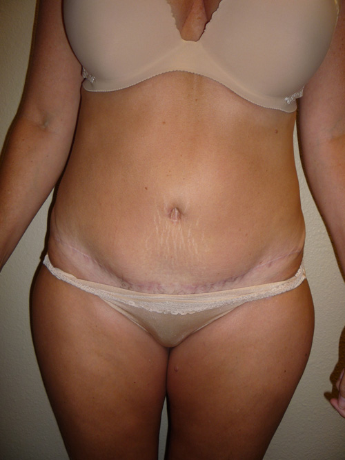 Tummy Tuck