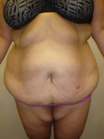 Tummy Tuck