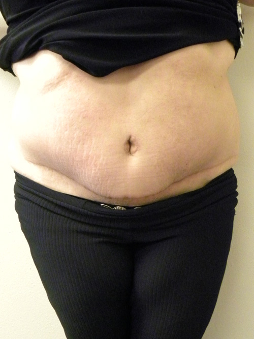 Tummy Tuck