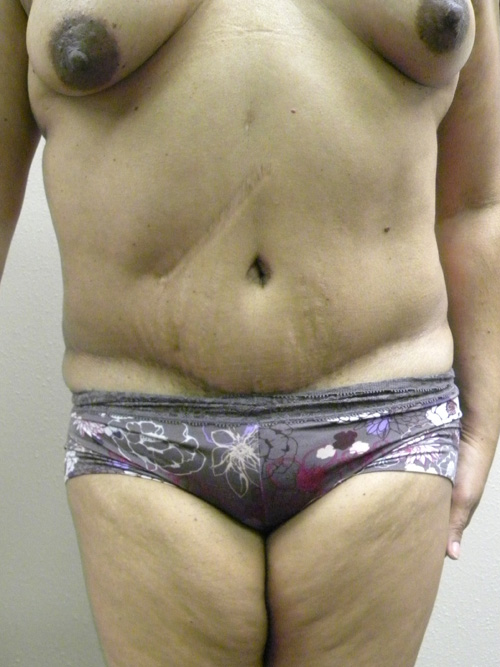 Tummy Tuck