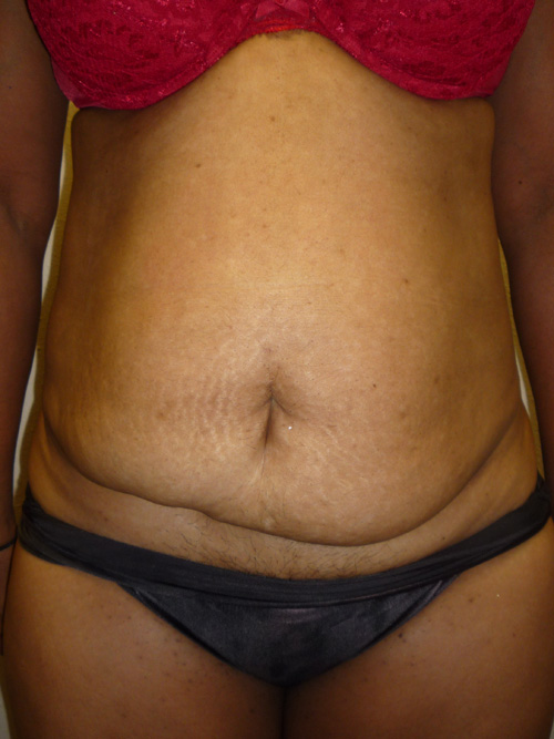 Tummy Tuck