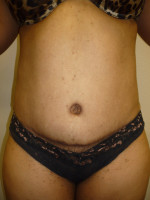 Tummy Tuck