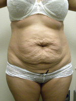 Tummy Tuck