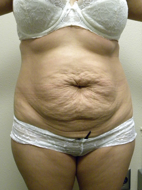 Tummy Tuck