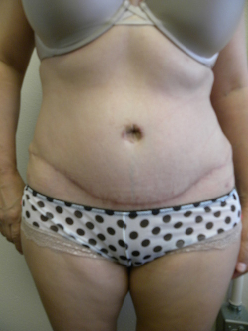 Tummy Tuck