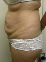 Tummy Tuck