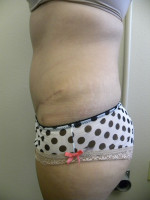 Tummy Tuck