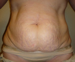 Tummy Tuck