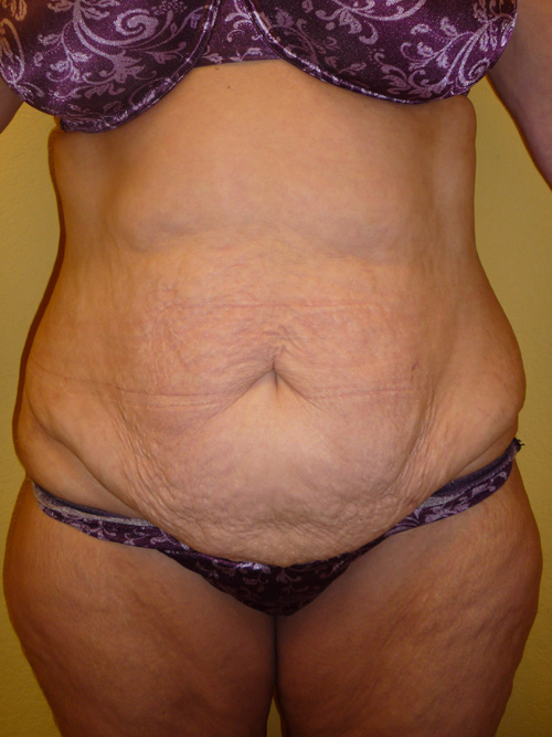 Tummy Tuck