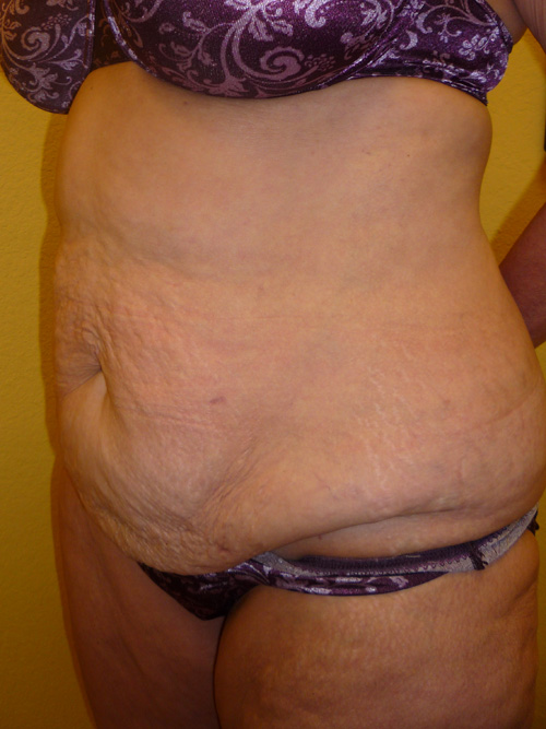 Tummy Tuck