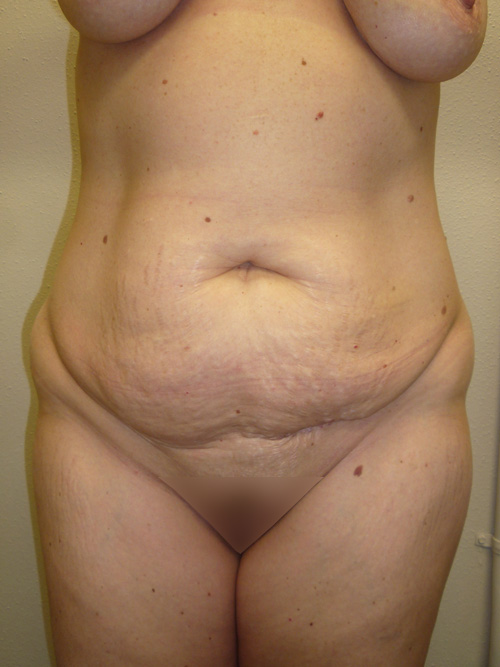 Tummy Tuck