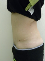 Tummy Tuck