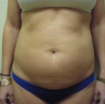 Tummy Tuck